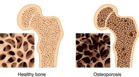 Osteochondrosis - disease of the century