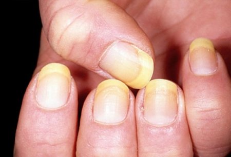 7 the most effective folk remedies for nail fungus