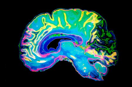 Brain implant against Alzheimer's disease
