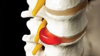 What hurts the spine hernias