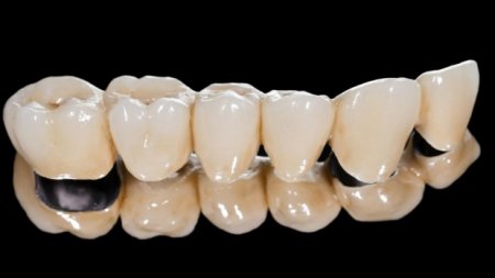 Pros and cons of metal-ceramic crowns