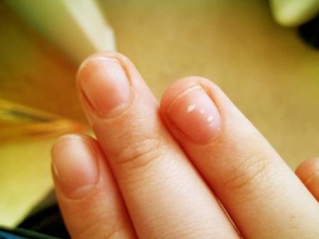 5 reasons white spots on nails