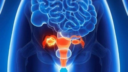 Experts call to increase the number of operations to remove the ovaries to fight cancer