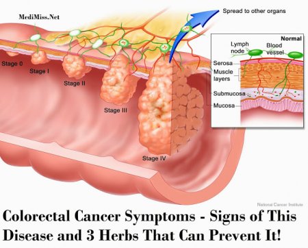    COLORECTAL CANCER SYMPTOMS - SIGNS OF THIS DISEASE AND 3 HERBS THAT CAN PREVENT IT!