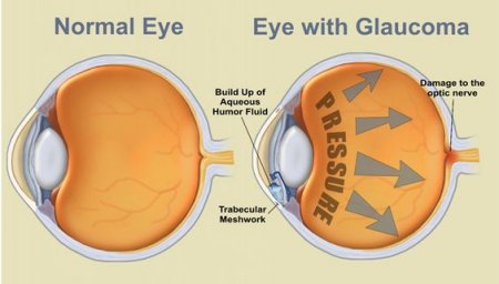 How to Prevent Glaucoma: 7 Important Things You Need to Know