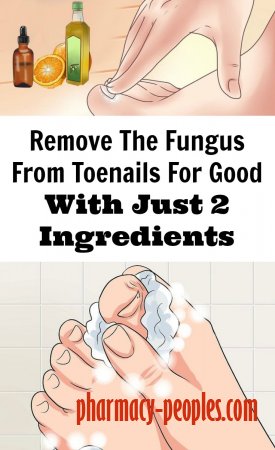 Remove The Fungus From Toenails For Good With Just 2 Ingredients